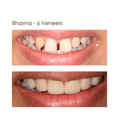 Bhavna - Six Veneers