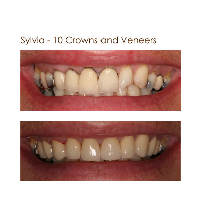 Sylvia - 10 Crowns and Veneers