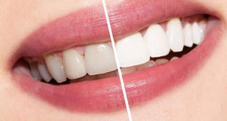 dentalessence Worthing tooth whitening offer